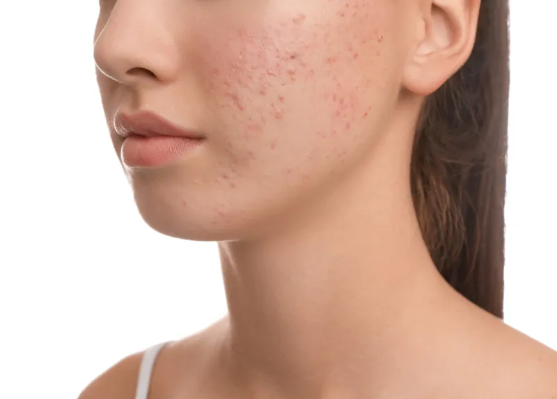 Acne scarring causing uneven skin texture on the face