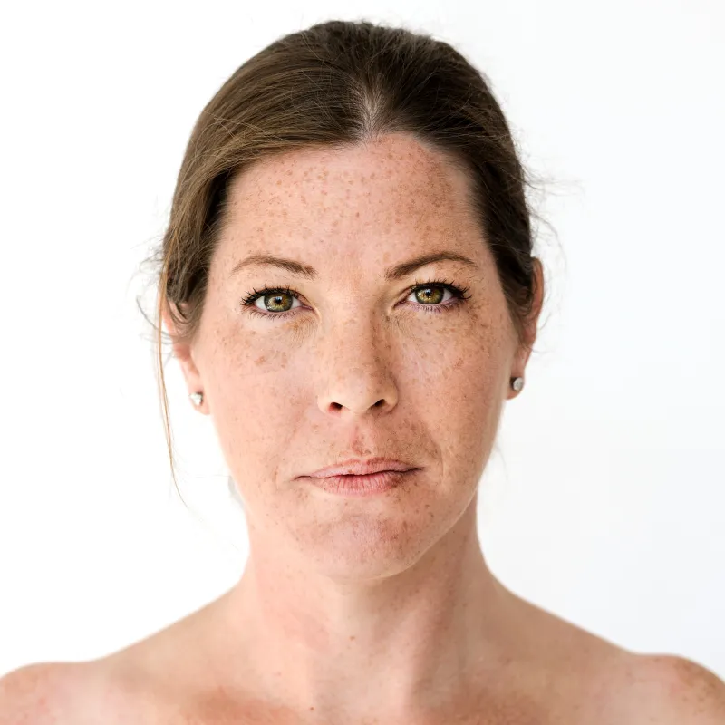 Age spots and sun spots on facial skin