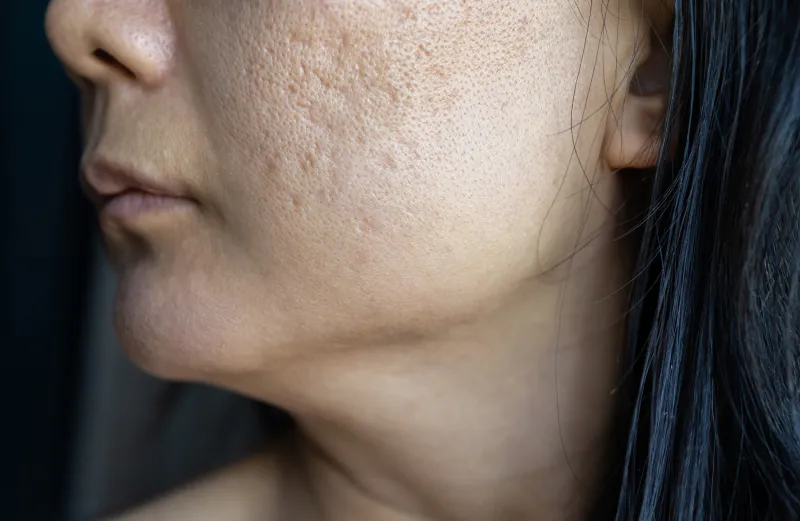 Atrophic and depressed acne scars on the face