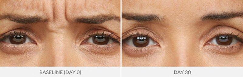 Botox forehead lines before and after results RK Medical Aesthetics Mississauga