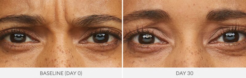 Botox frown lines 11s before and after treatment Mississauga GTA