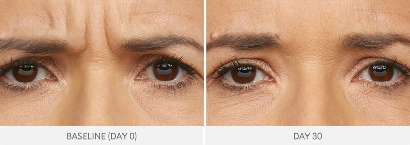 Botox crow's feet wrinkle reduction before and after Mississauga