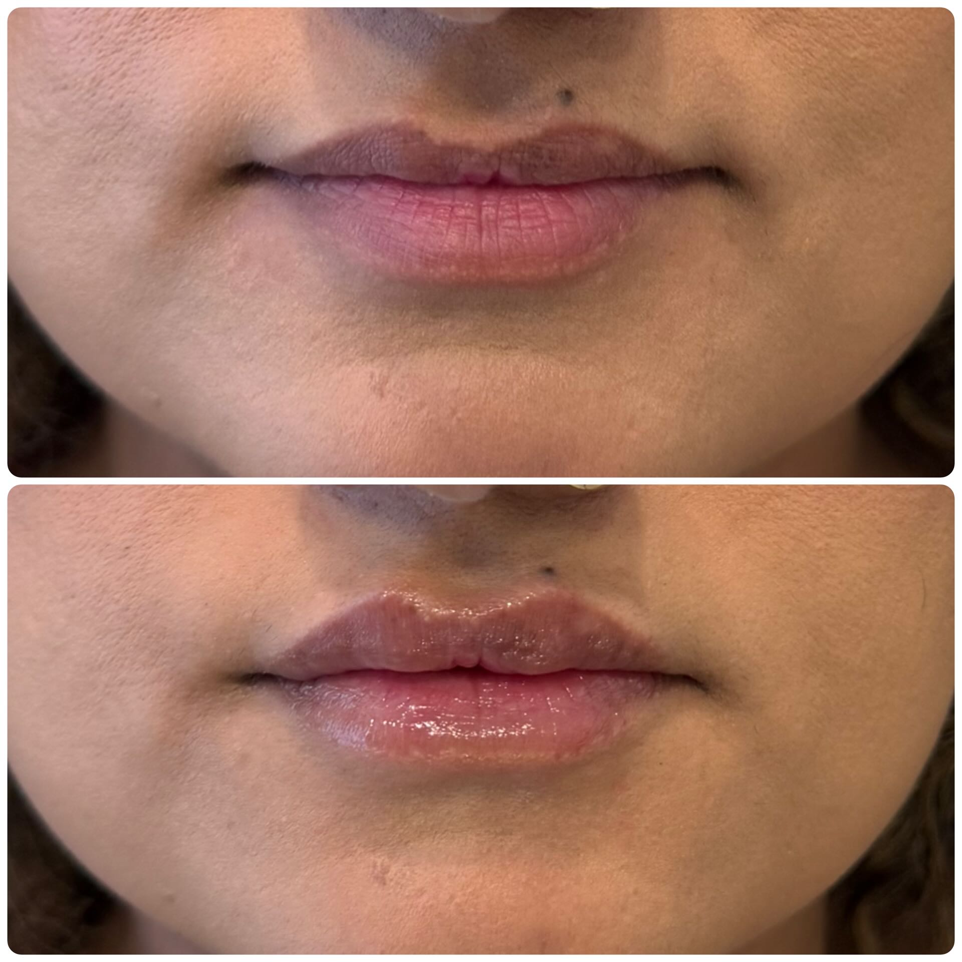 Fuller lips dermal filler treatment before and after Mississauga – after