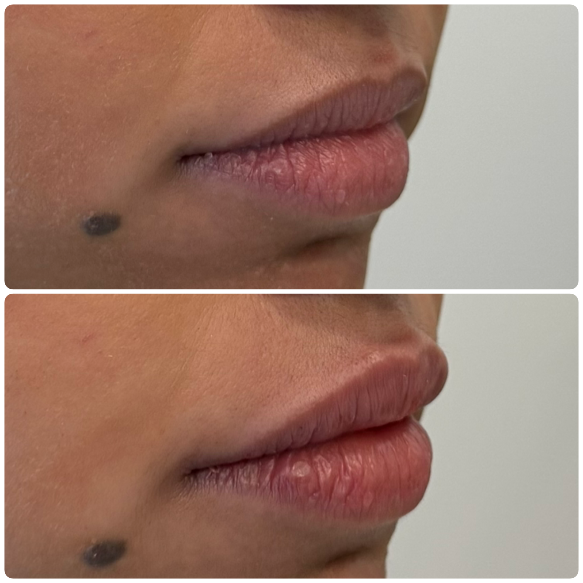 Dermal filler lip volume restoration before and after Mississauga GTA – after