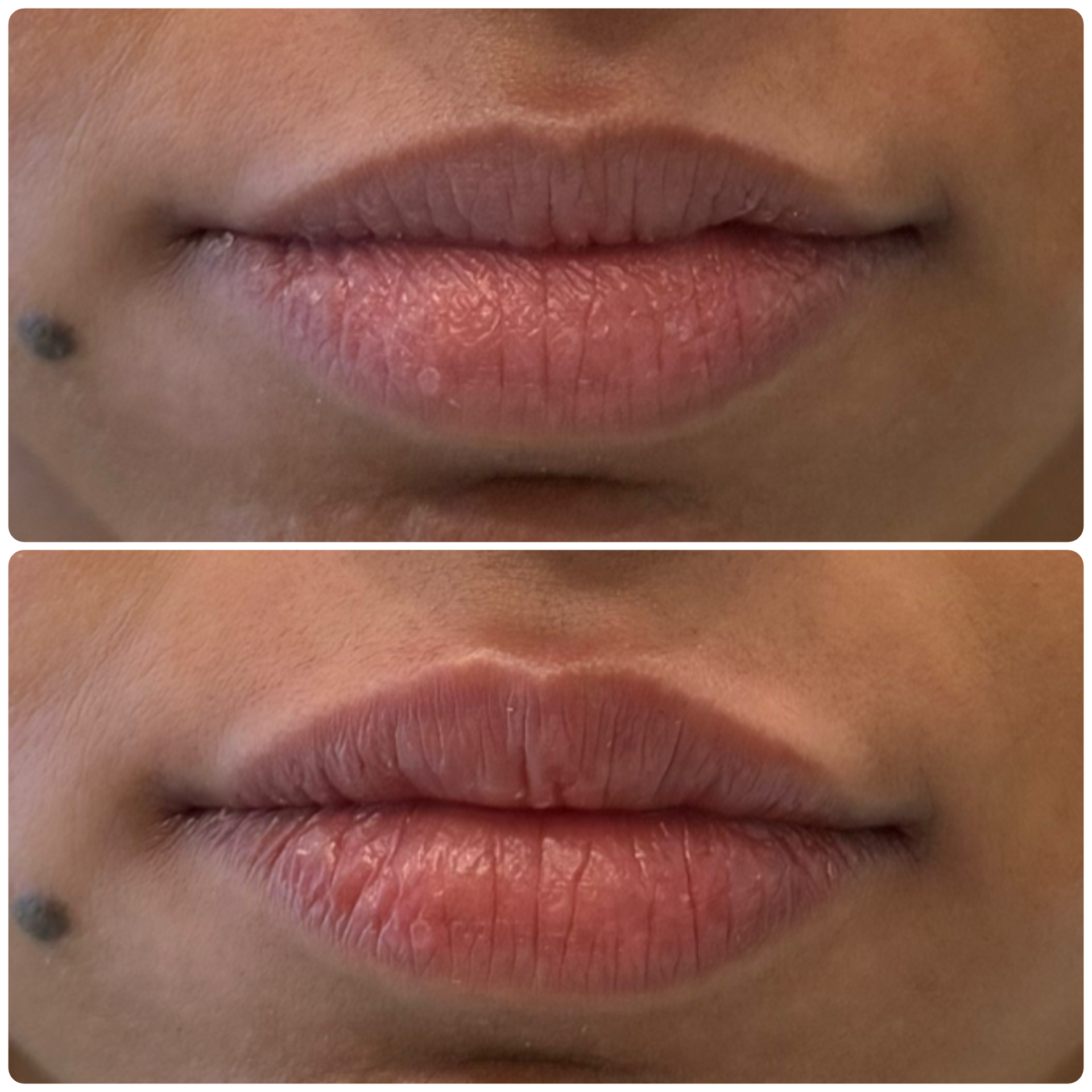 Natural lip filler subtle definition before and after Mississauga – after