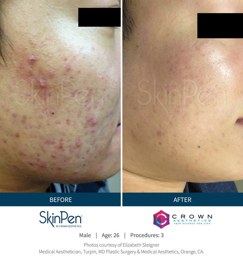 SkinPen microneedling acne scar before and after results RK Medical Aesthetics Mississauga