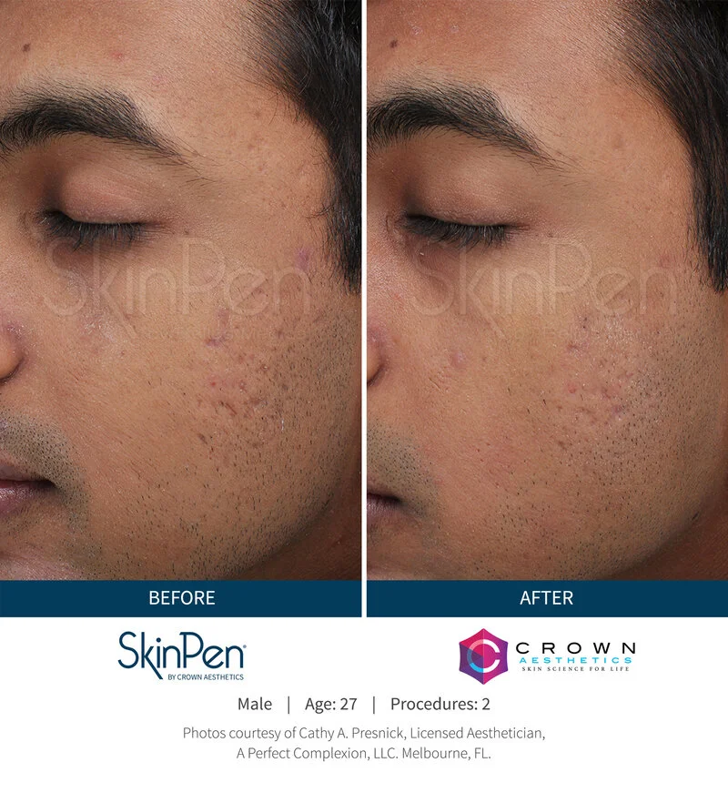 SkinPen microneedling skin texture improvement before and after Mississauga