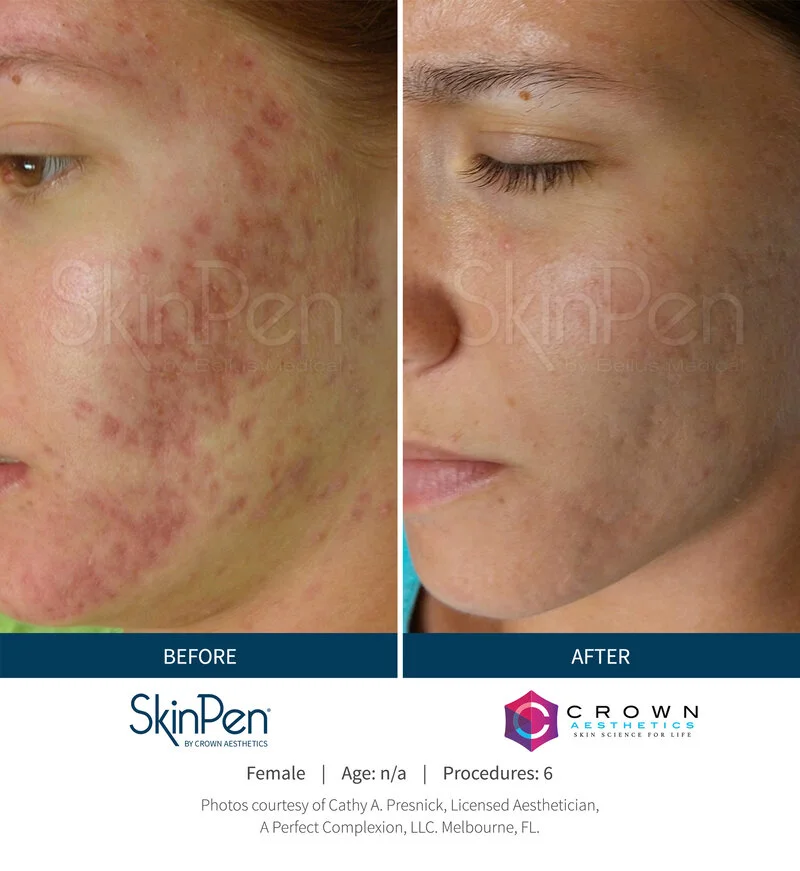 SkinPen microneedling acne scar reduction before and after treatment