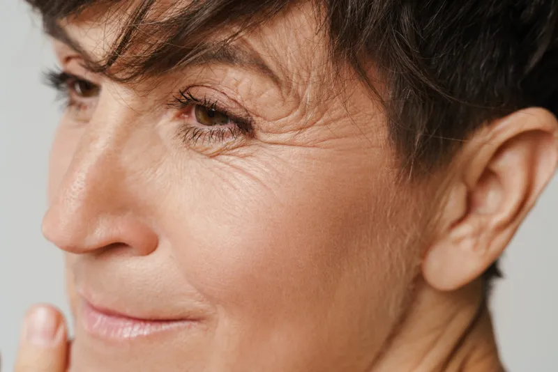 Crow's feet wrinkles around the eyes treatment