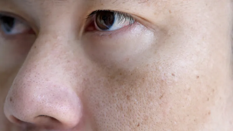 Enlarged pores on facial skin