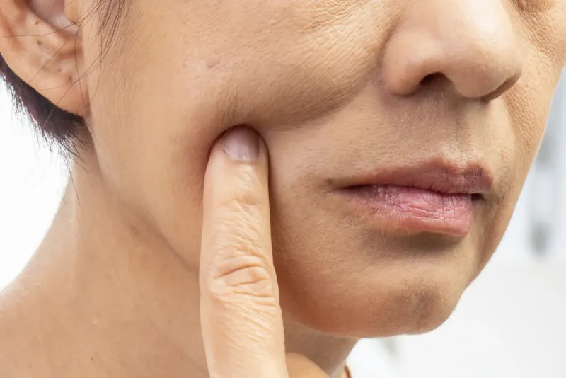 Facial skin laxity and sagging along the jawline