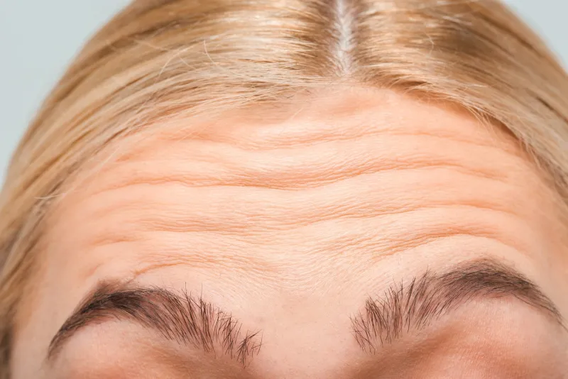Forehead wrinkles treatment at RK Medical Aesthetics