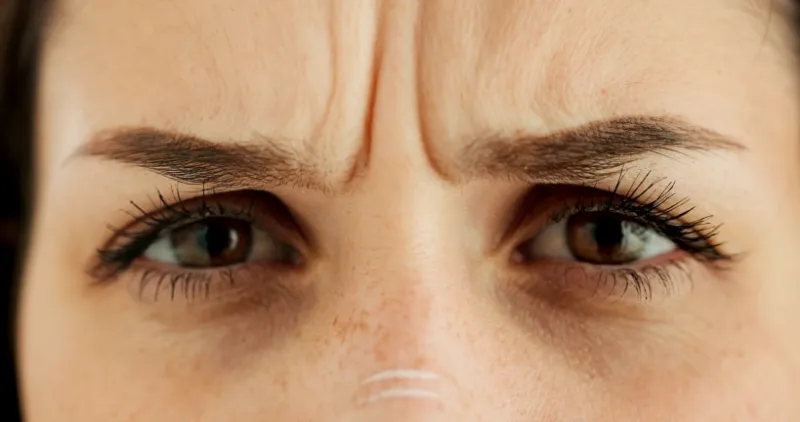 Frown lines treatment between eyebrows