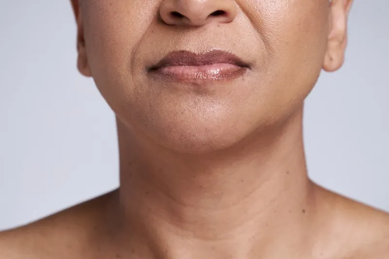 Hollow cheeks and facial volume loss