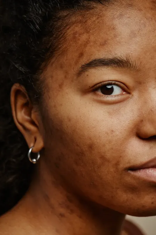 Post-inflammatory hyperpigmentation from acne on facial skin