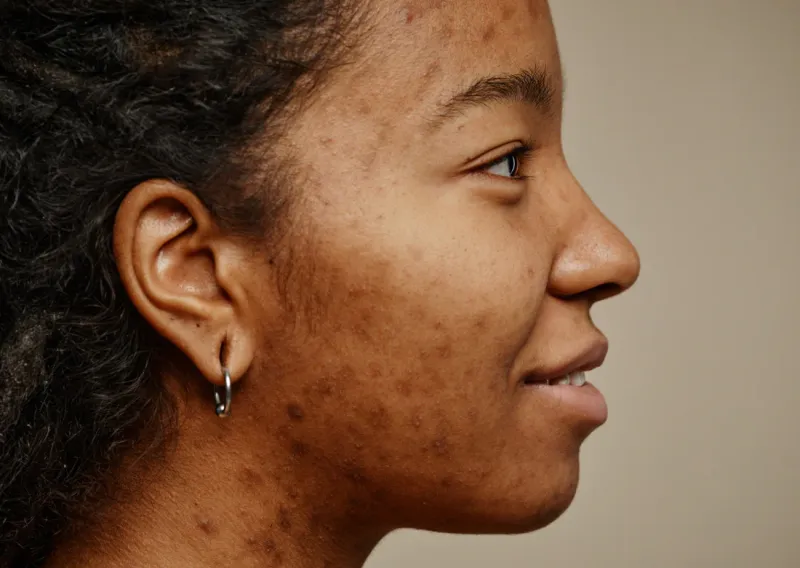 Hyperpigmentation and dark spots on facial skin