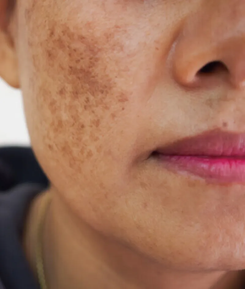 Melasma brown patches on the face