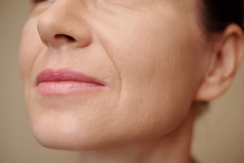 Nasolabial folds and smile lines on the face