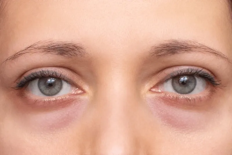 Pigmented dark circles under the eyes
