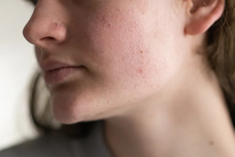 Rough and dull skin texture on the face