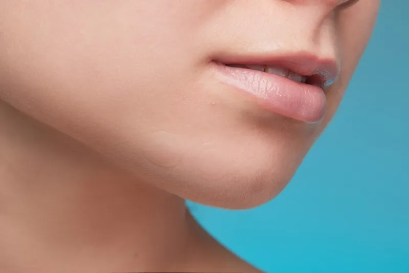 Thin lips before lip filler treatment