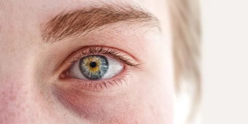 Tear trough hollowing and under-eye shadows